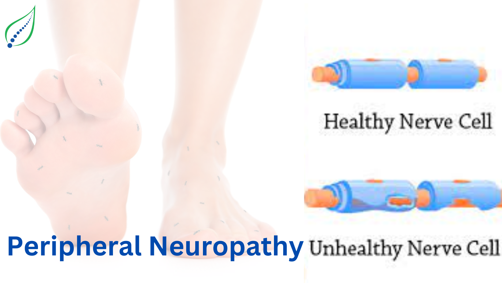 Peripheral Neuropathy